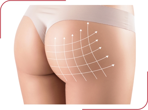 Buttock Augmentation - Invivo Hospitals