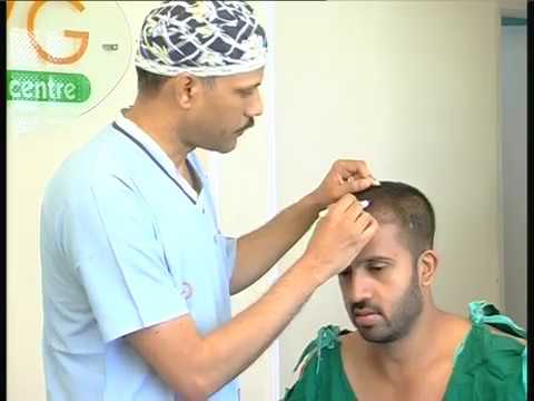 Hair Transplant - Mr Rohan Gowda